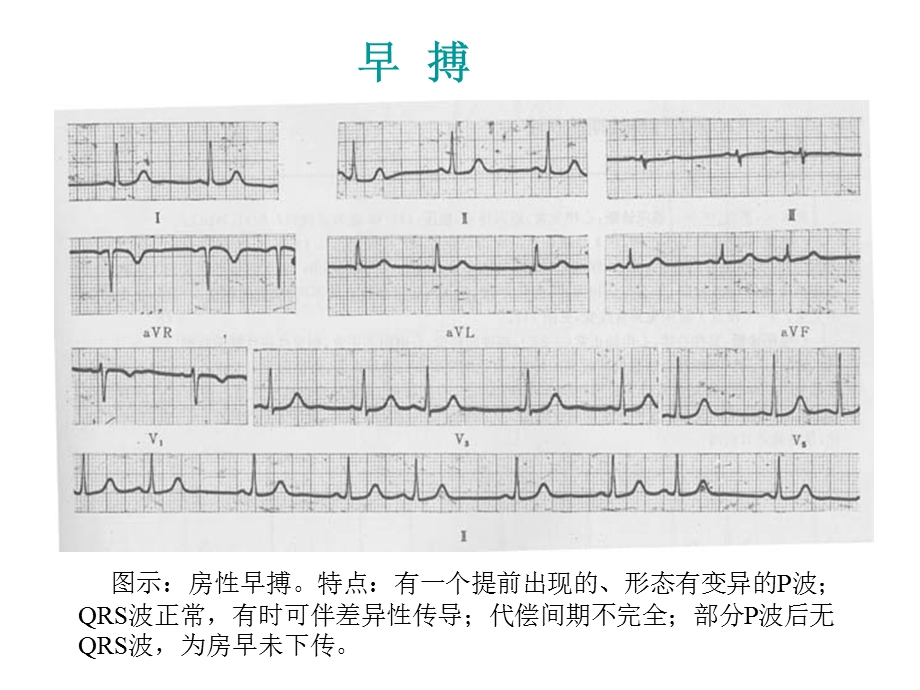 最新：复杂心电图读片ppt课件文档资料.ppt_第1页