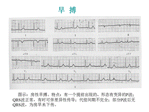 最新：复杂心电图读片ppt课件文档资料.ppt