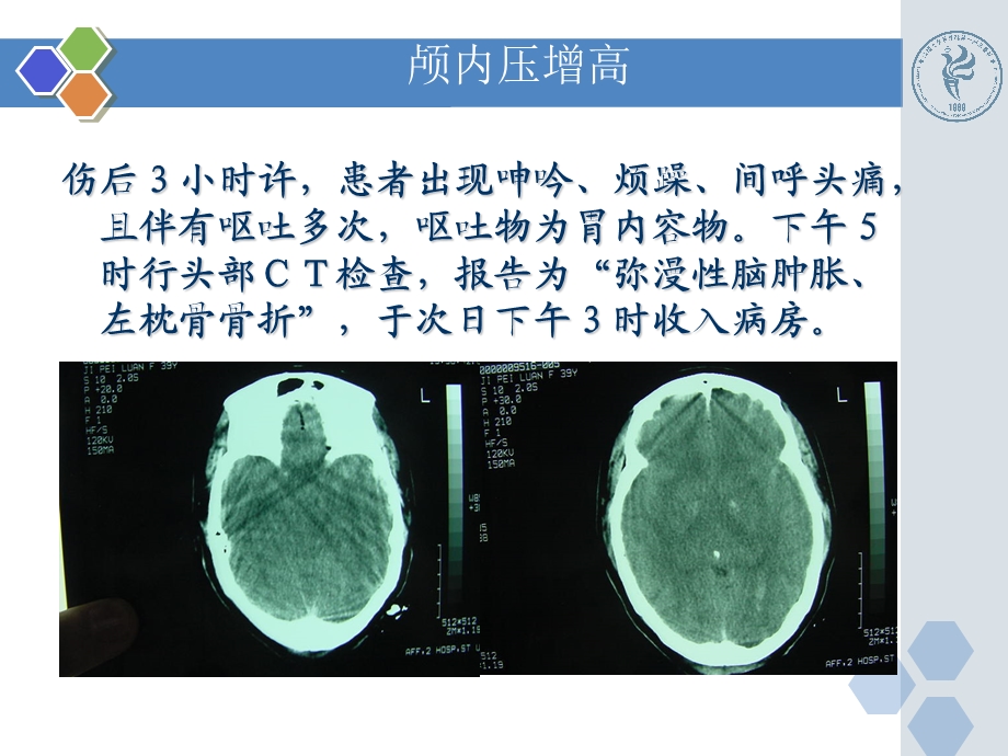 最新新版颅内压增高病例PPTPPT文档.ppt_第3页