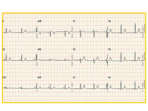 最新正常心电图ppt课件PPT文档.ppt