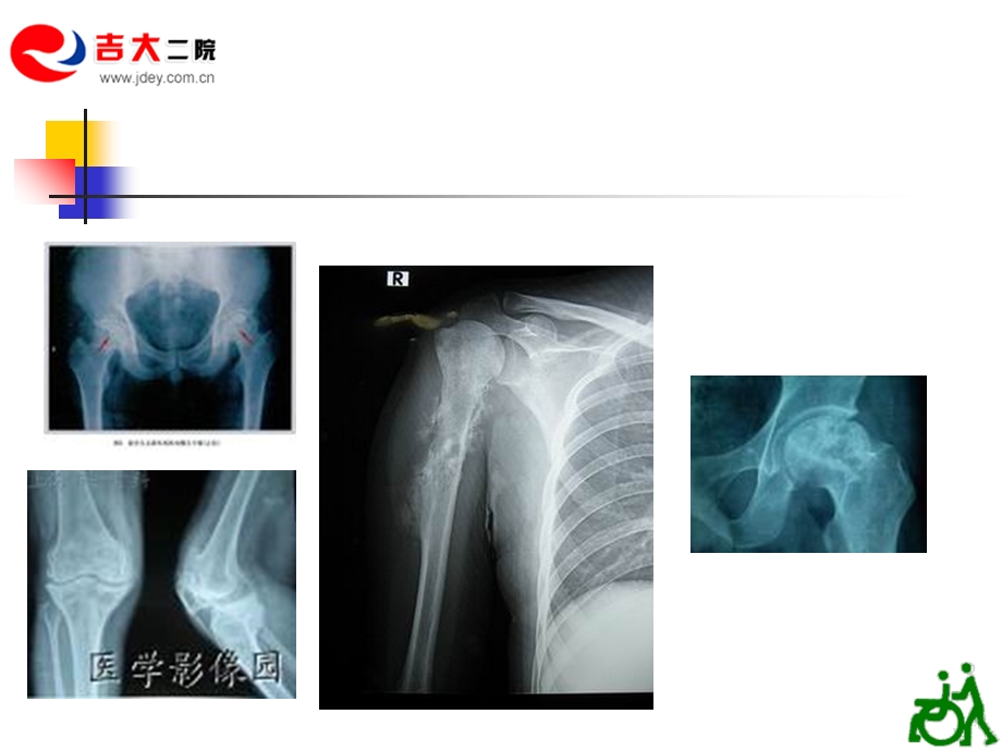 关节置换术的评定PPT课件.ppt_第3页