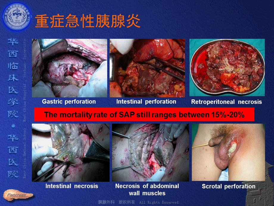 最新重症急性胰腺炎外科治疗大综合PPT文档.ppt_第1页