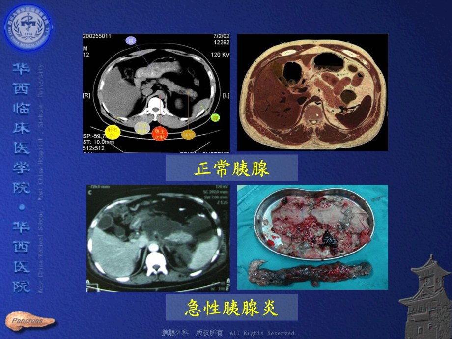 最新重症急性胰腺炎外科治疗大综合PPT文档.ppt_第2页