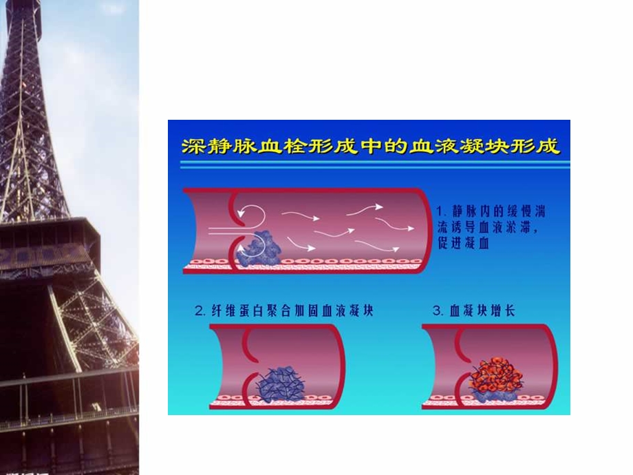 最新下肢深静脉血栓溶栓护理PPT文档.ppt_第2页