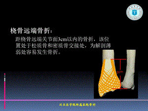 掌背侧钢板治疗桡骨远端骨折ppt课件文档资料.ppt