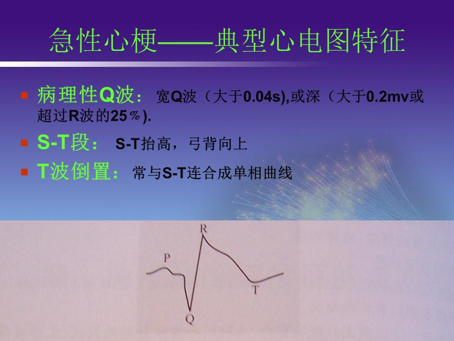 最新心梗的心电图知识1PPT文档.ppt_第3页