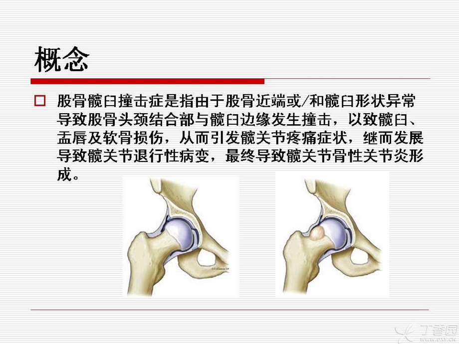 最新：髋臼股骨撞击综合症ppt课件文档资料.ppt_第1页