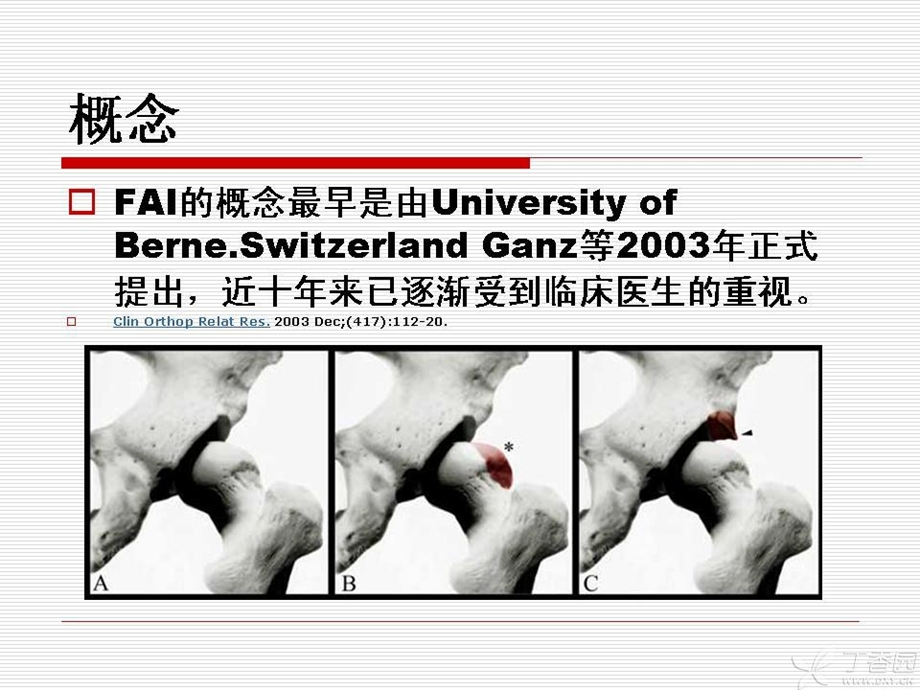 最新：髋臼股骨撞击综合症ppt课件文档资料.ppt_第2页