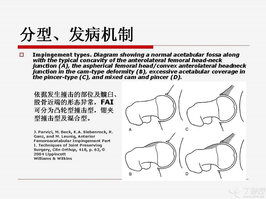 最新：髋臼股骨撞击综合症ppt课件文档资料.ppt_第3页