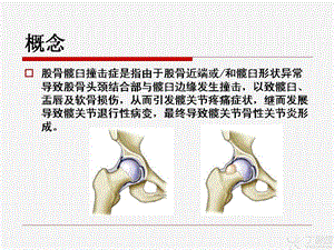 最新：髋臼股骨撞击综合症ppt课件文档资料.ppt