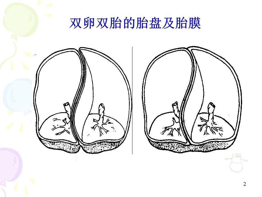 双胎输血综合症精选文档.ppt_第2页