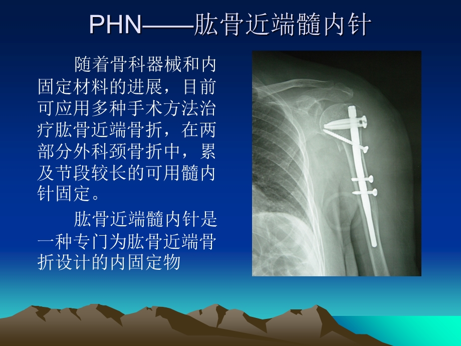 应用髓内针治疗肱骨外科颈骨折文档资料.ppt_第2页