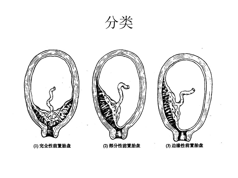 最新：前置胎盘护理文档资料.ppt_第2页