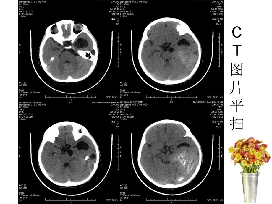 神经节细胞胶质瘤文档资料.ppt_第1页