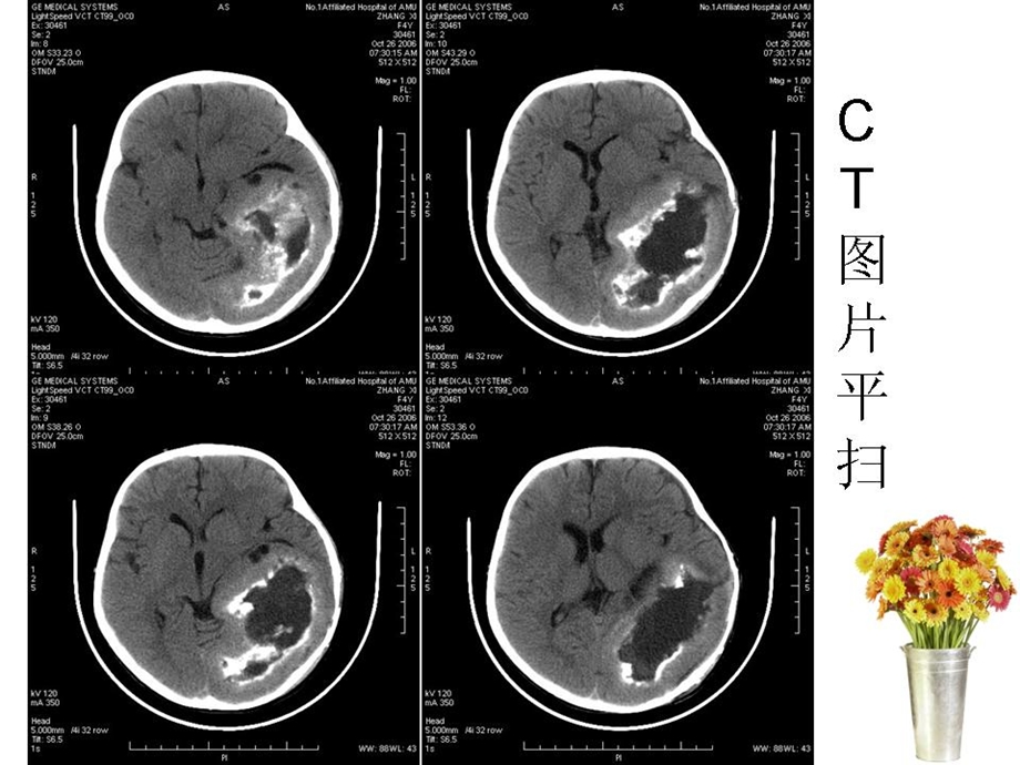 神经节细胞胶质瘤文档资料.ppt_第2页