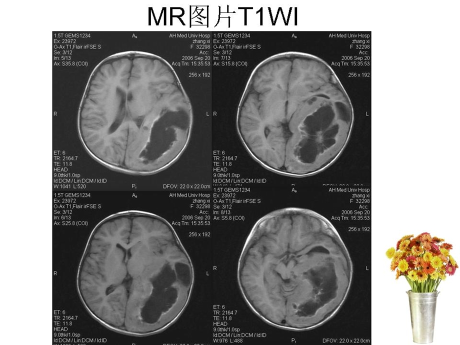 神经节细胞胶质瘤文档资料.ppt_第3页