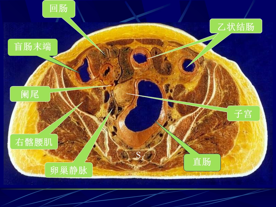 最新女性盆部断面解剖PPT文档.ppt_第3页