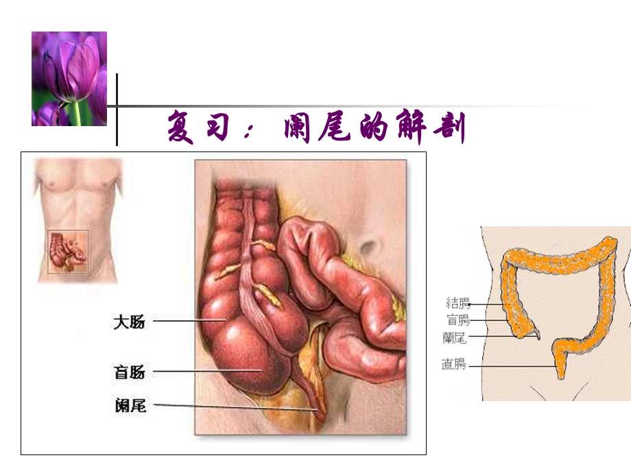 急性阑尾炎病人的护理专文档资料.ppt_第2页