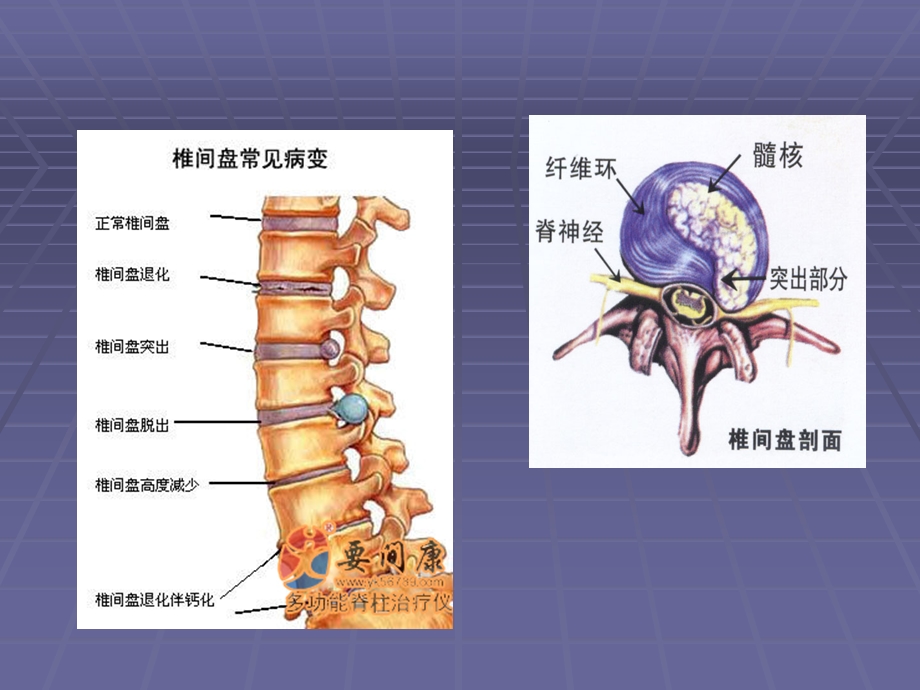 腰椎间盘突出症全解文档资料.ppt_第1页