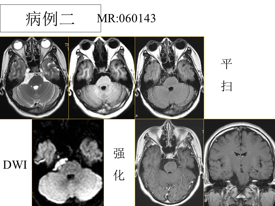 头颈部MRI图片下文档资料.ppt_第3页