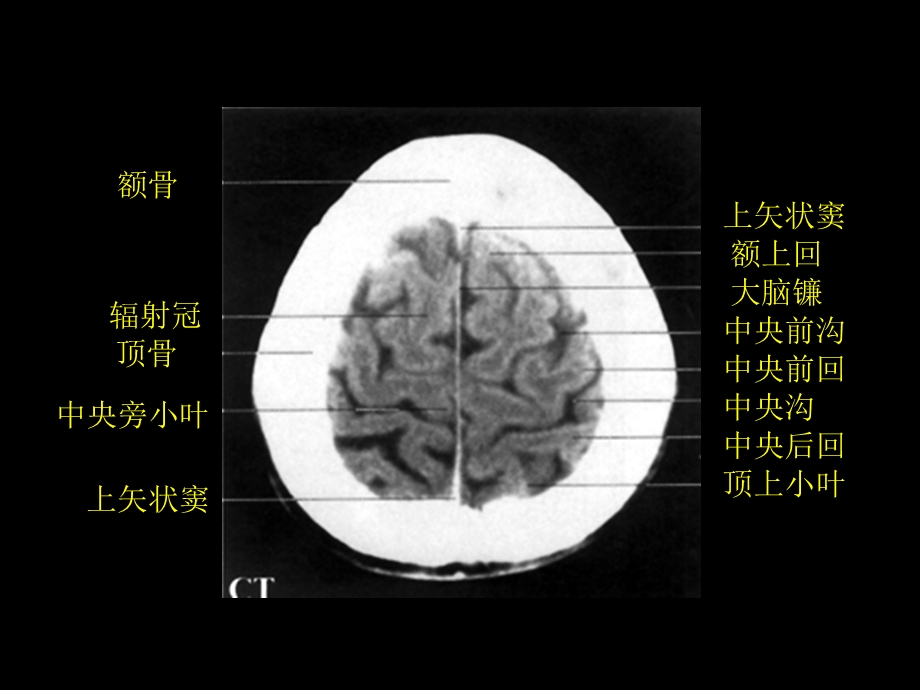 最新：颅脑正常CT与MRI课件文档资料.ppt_第2页