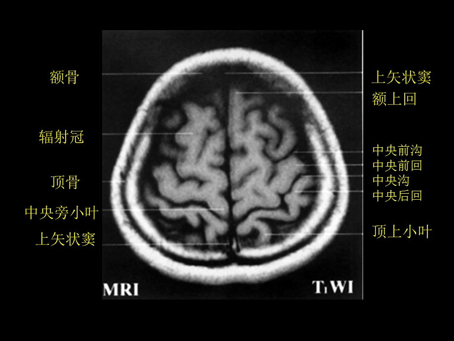 最新：颅脑正常CT与MRI课件文档资料.ppt_第3页