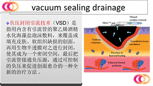 最新：培训资料vsd护理查房文档资料.ppt