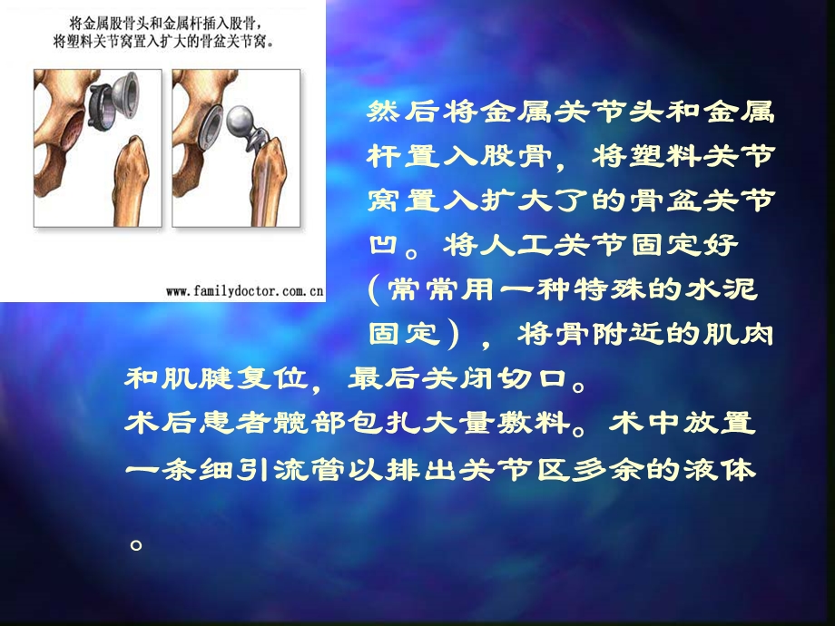 最新人工关节置换术护理PPT文档.ppt_第3页