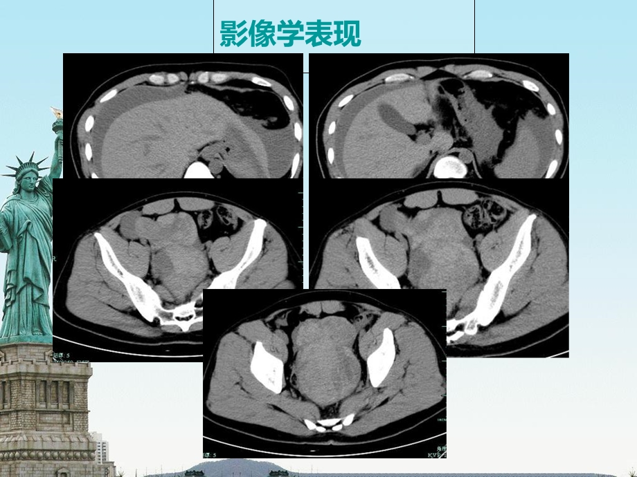 PNET的病例讨论文档资料.ppt_第2页