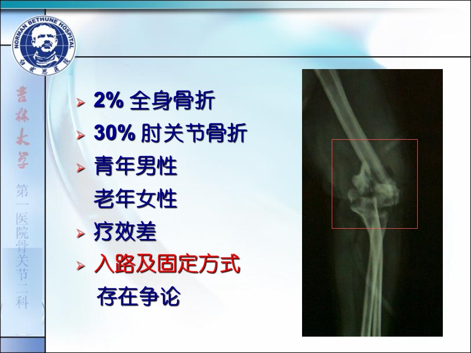 复杂肱骨远端关节内骨折手术入路及固定方式的选择文档资料.ppt_第1页