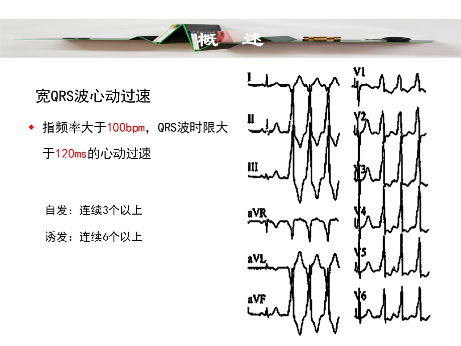 宽QRS群心动过速鉴别诊断新思路北京大学人民医院文档资料.ppt_第2页