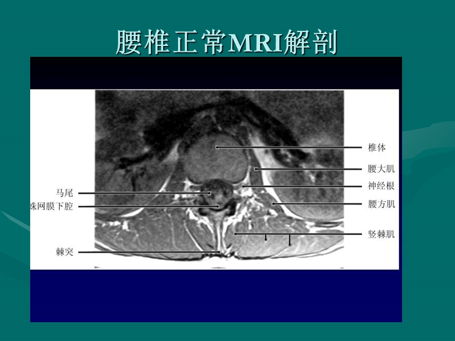 最新腰椎间盘的MRI诊断PPT文档.ppt_第3页