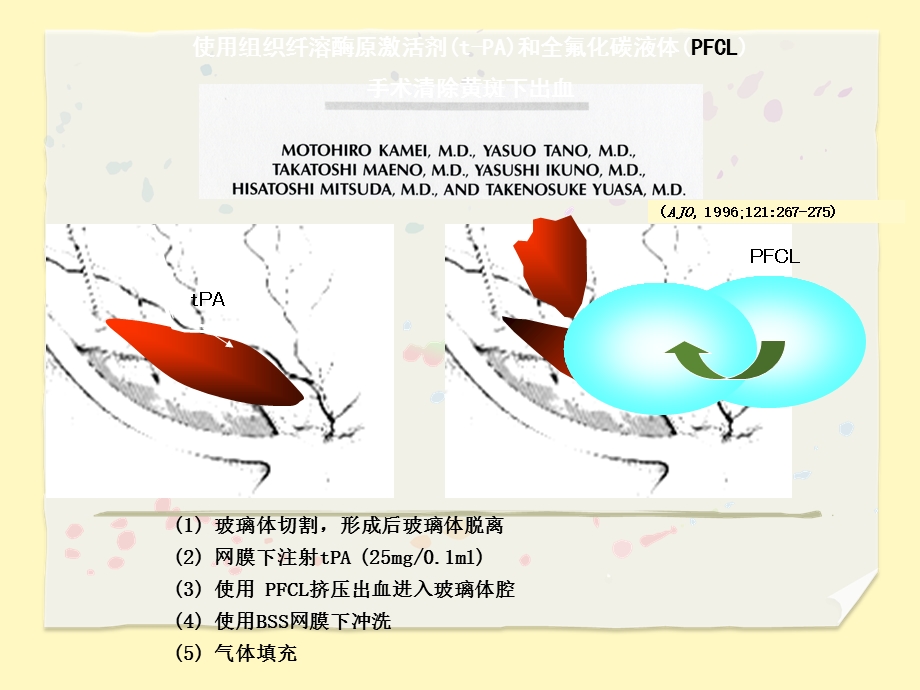 手术治疗视网膜下出血PPT文档资料.ppt_第3页