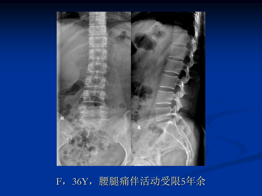 最新：椎管内肿瘤病例随访ppt课件文档资料.ppt_第1页