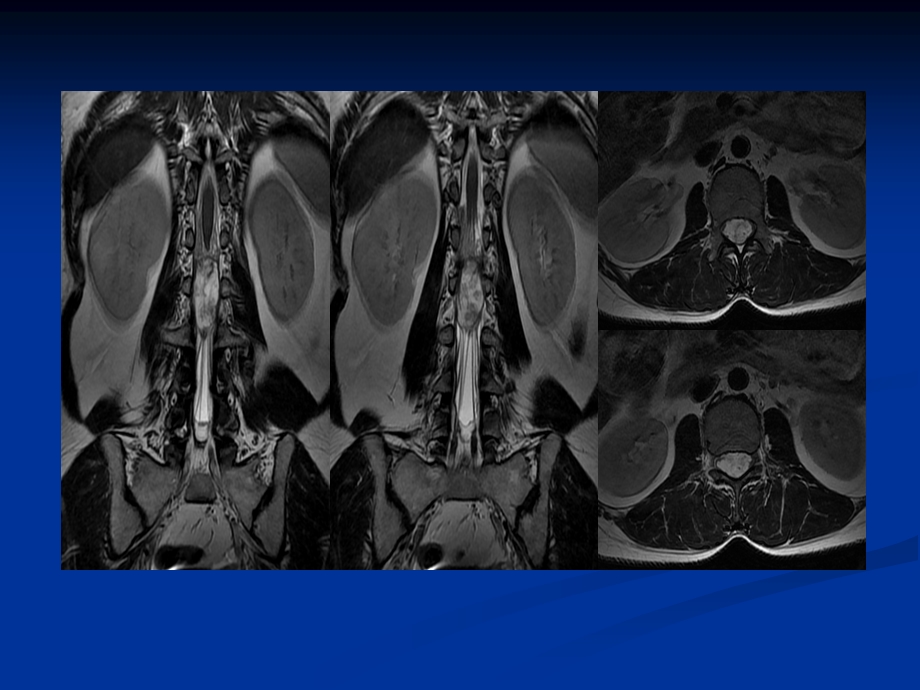 最新：椎管内肿瘤病例随访ppt课件文档资料.ppt_第3页