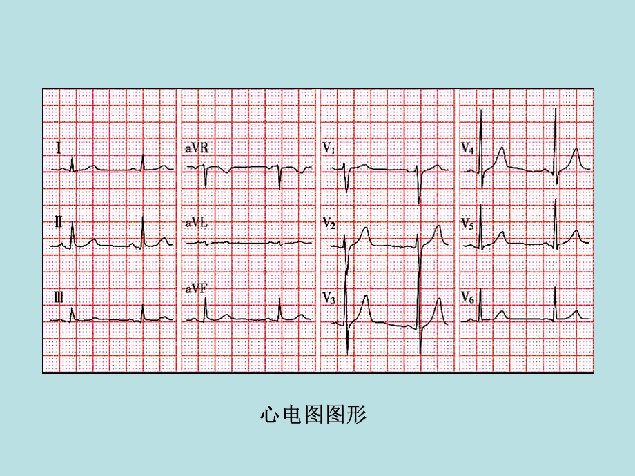 如何阅心电图PPT文档.ppt_第2页