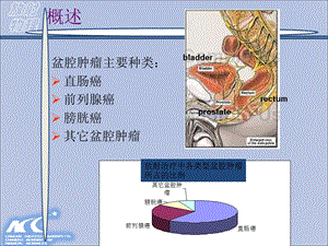 盆腔肿瘤放射治疗疗计划的设计精选文档.ppt