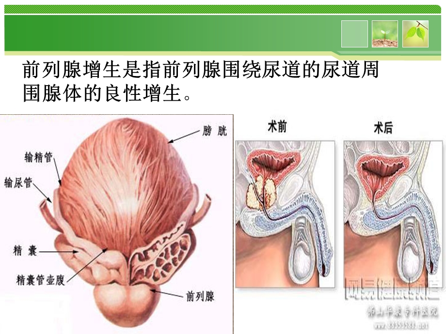 最新前列腺围手期护理分析课件PPT文档.ppt_第3页