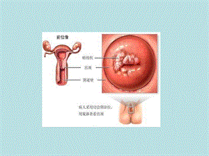 宫颈癌床诊断及分期PPT文档资料.ppt