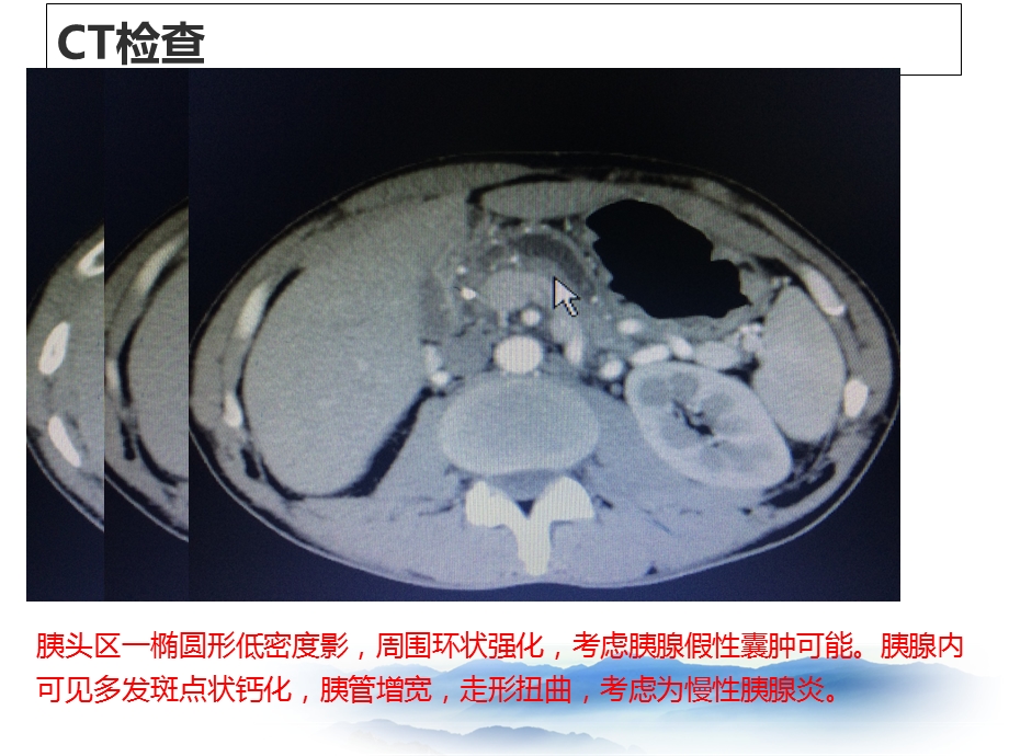 最新慢性胰腺炎的ercp胰管支架植入术ppt课件PPT文档.ppt_第3页