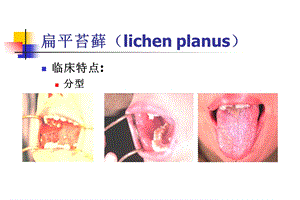 最新第五章口腔黏膜2PPT文档.ppt