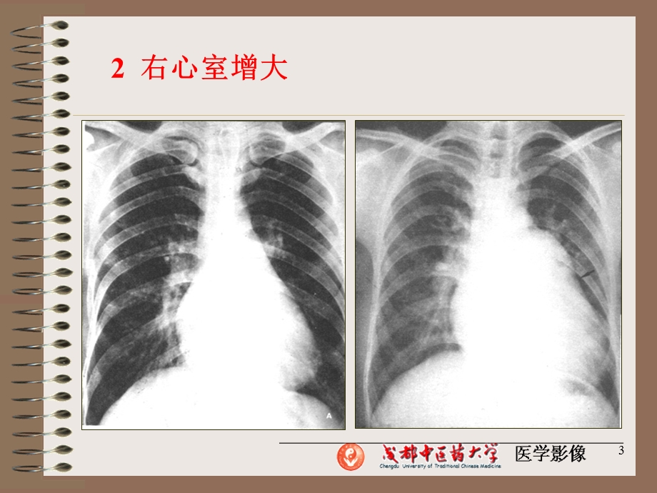 心脏基本病变X线表現文档资料.ppt_第3页