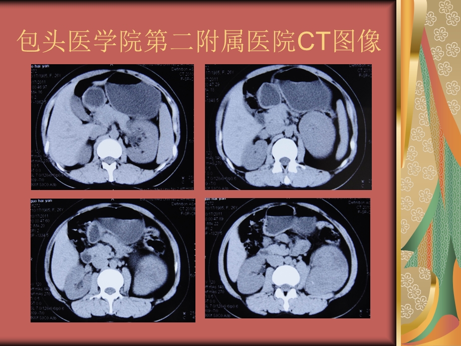 最新腹膜后非典型性孤立性纤维性肿瘤病例讨论ppt课件PPT文档.ppt_第3页