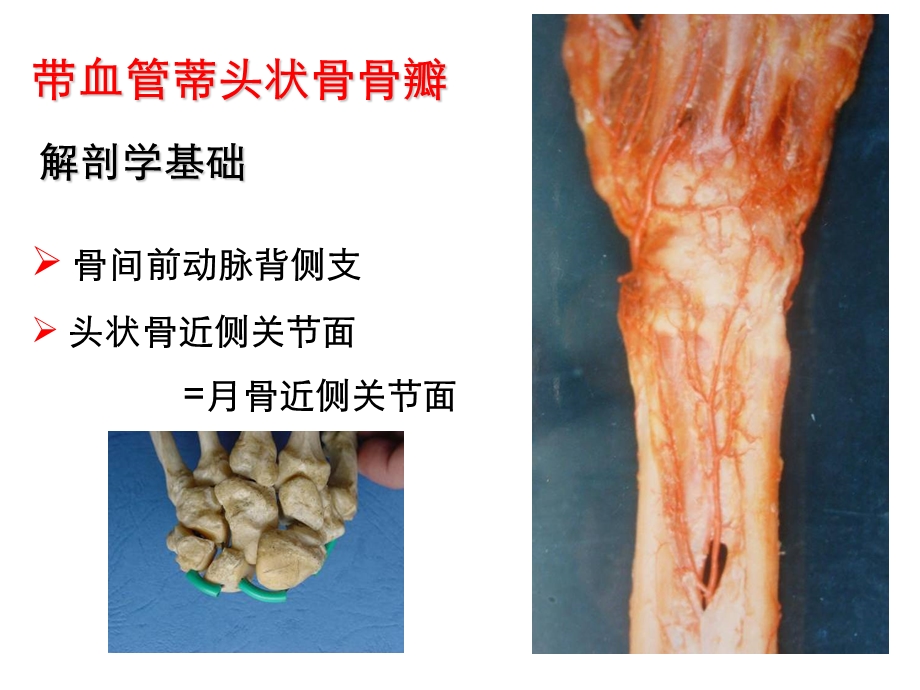 带血管蒂头状骨骨瓣治疗晚期课件文档资料.ppt_第2页