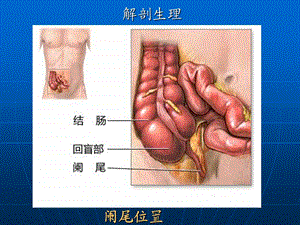 33阑尾炎,李威PPT文档资料.ppt