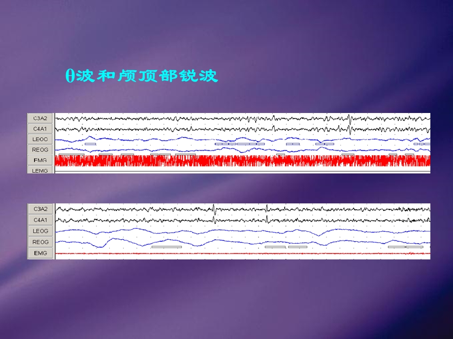 最新成人脑电图的判读及睡眠分期PPT文档.ppt_第3页