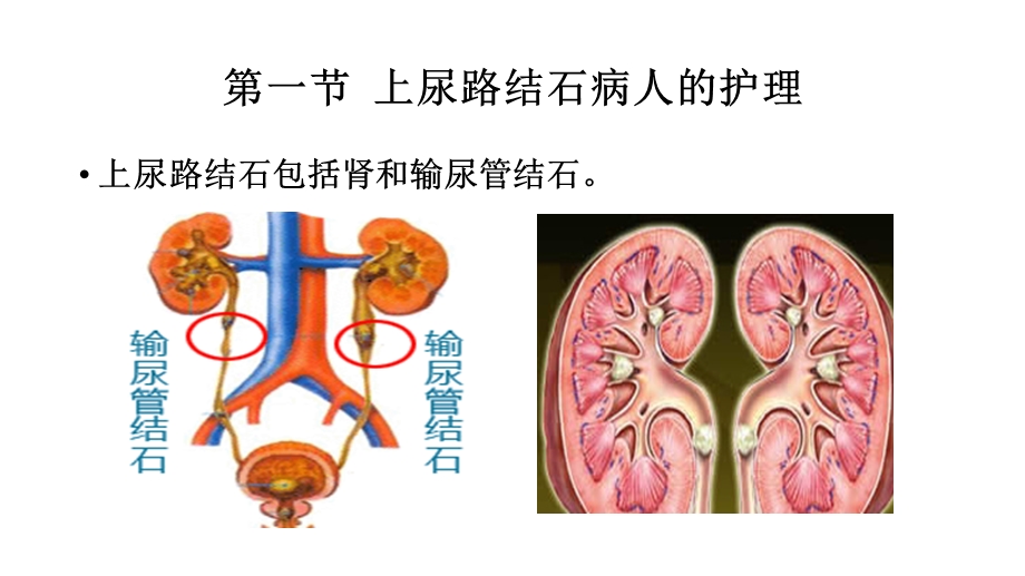 尿石症病人的护理精选文档.pptx_第2页