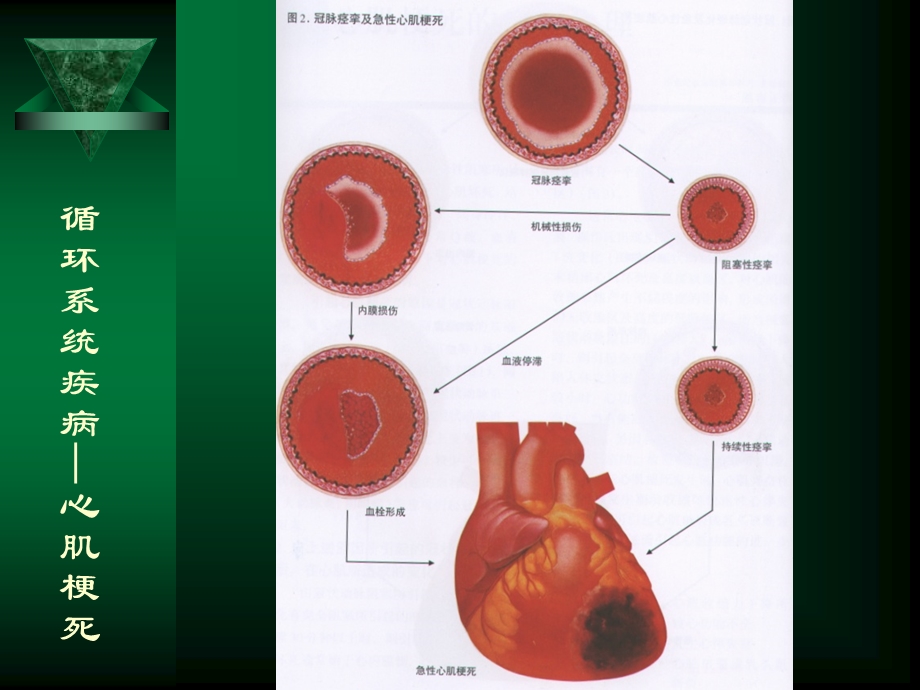 最新：循环系统疾病—心肌梗死文档资料.ppt_第2页