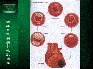 最新：循环系统疾病—心肌梗死文档资料.ppt