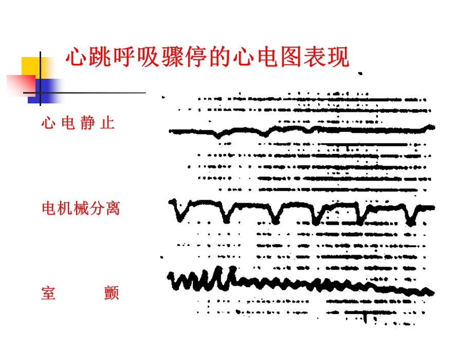 心脏除颤、复律PPT课件.ppt_第3页